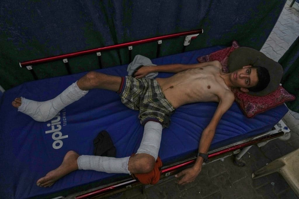 Ahmad Sbeteh, de 17 años, herido por la metralla de un ataque contra una casa vecina, ha perdido unos 15 kilos, y los médicos afirman que la falta de alimentos sanos y suplementos nutricionales está ralentizando su recuperación en el hospital Shifa de la ciudad de Gaza el lunes 18 de agosto de 2025. Antes de la herida de metralla, no padecía ninguna enfermedad preexistente, según los médicos.