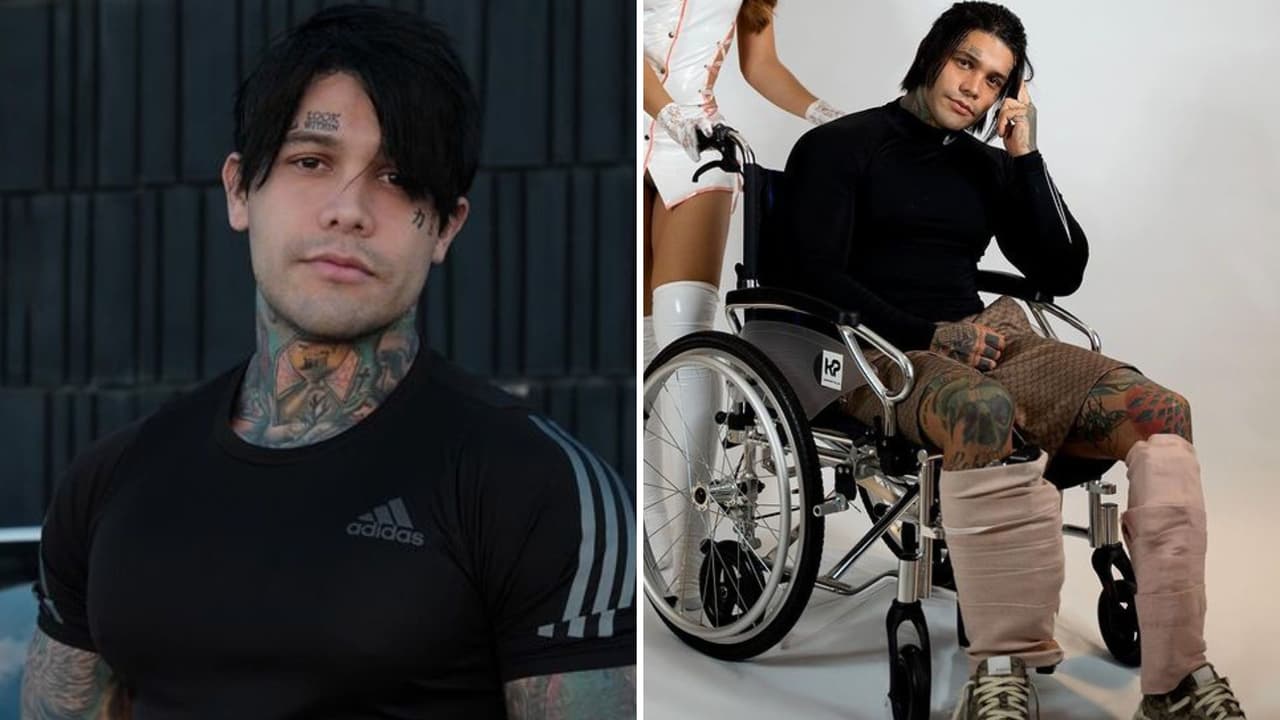 Influencer se somete a cirugía de alargamiento de piernas y vive traumática recuperación: esto es lo que creció