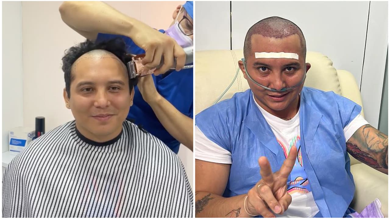 Edwin Luna se sometió a un trasplante capilar porque se "estaba quedando sin tierra en la maceta"