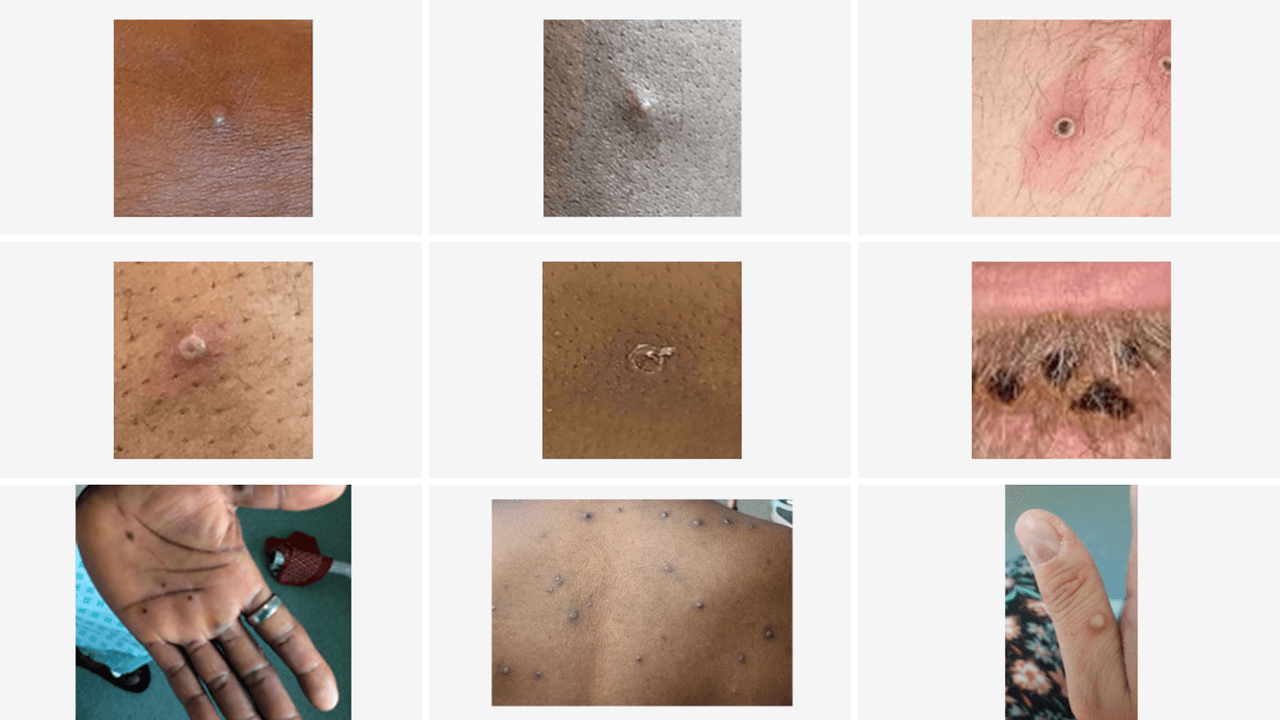 <b>¿En qué punto de la infección es más contagiosa?</b>
<br>
<br>“Las lesiones activas son más contagiosas que las costras”, aclaró Del Río. Aclarando que cuando un paciente tiene las ampollas completamente formadas, es el punto más alto de riesgo de contagios.
<br>