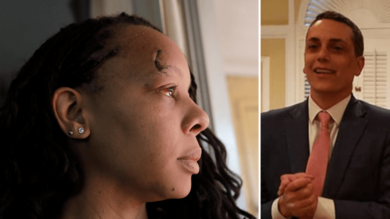 “Usted disculpe”: le dispararon en la cara y le piden perdón 8 meses después en Fort Lauderdale