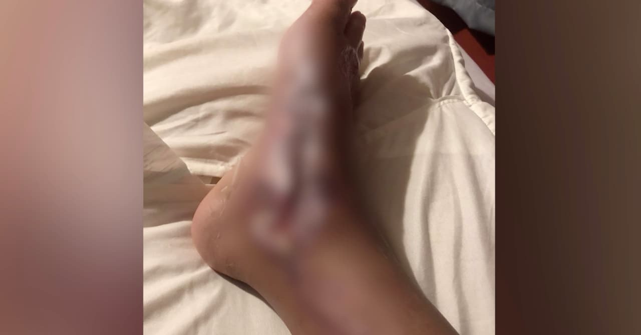 Alertan ante incremento de casos de bacteria come carne en Florida tras el huracán Ian