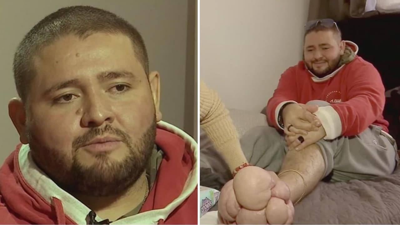 <b>Mira el caso completo y haz <a href="https://www.univision.com/shows/primer-impacto/ayuda-de-impacto-joven-sufre-de-elefantiasis-enfermedad-que-le-provoca-el-crecimiento-excesivo-de-sus-pies-colombia" target="_blank">clic aquí para conocer cómo ayudarlo. </a></b>