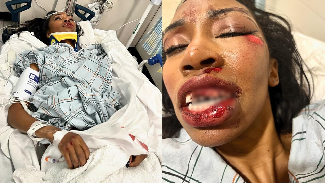 La actriz de Marvel, Carrie Bernans, sufrió múltiples lesiones, fracturas y rupturas de dientes tras ser atropellada.