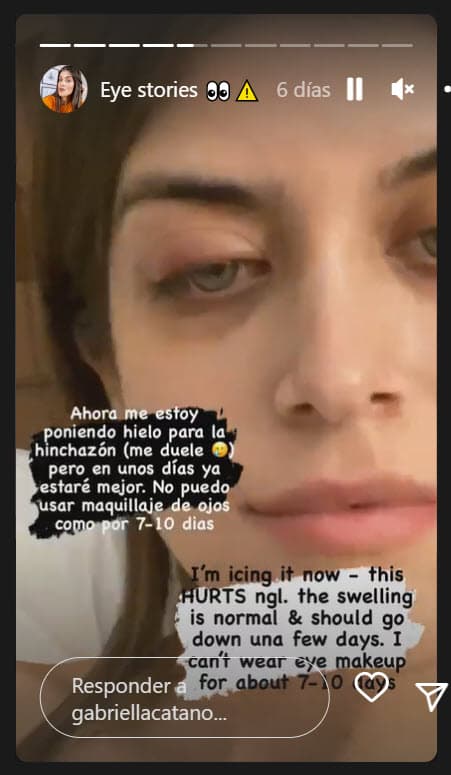 La primogénita del actor de telenovelas como 
<b><a href="https://vix.com/es/detail/series-661?utm_medium=internal_referral&utm_source=univision&utm_campaign=breaking_news&utm_content=ed_entertainment&utm_term=slideshow" target="_blank">Fuego En La Sangre, que puedes ver gratis aquí en ViX</a></b>, mencionó que su ojo aún "lagrimea", pero que es una "sensación normal" tras el procedimiento al que se sometió. 
<br>