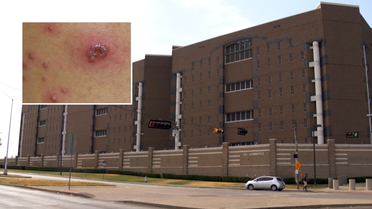 Indagan posible caso de la viruela del mono en la cárcel del condado Dallas 