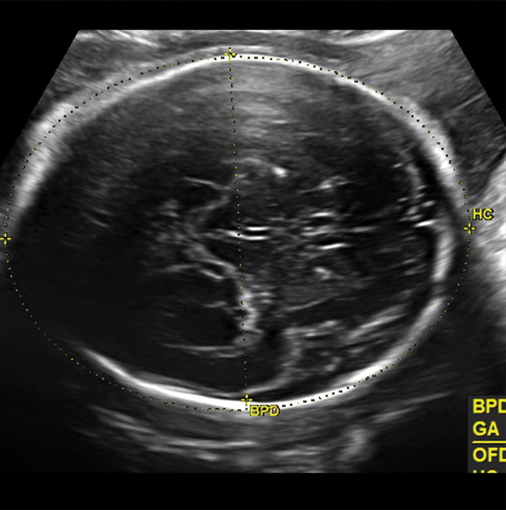 Su infección de zika fue confirmada en el Instituto de Pesquisa de Campina Grande, en Brasil.