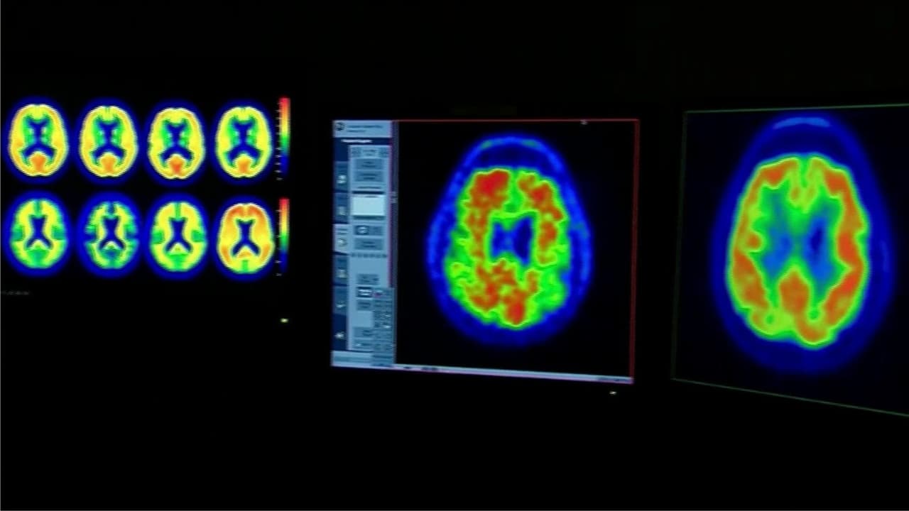 ¿Qué es una dieta antiinflamatoria y cómo reduce el riesgo de enfermedades cerebrales?