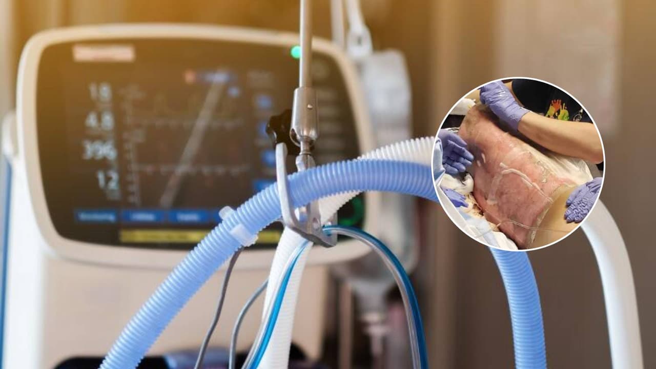 Reto de TikTok deja a niño de 12 años con graves quemaduras y conectado a un respirador