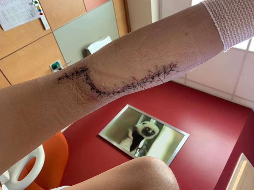 Una niña de 12 años que se encontraba de vacaciones en Florida, también fue infectada con la fascitis necrosante en su pierna, después de ir a la playa.