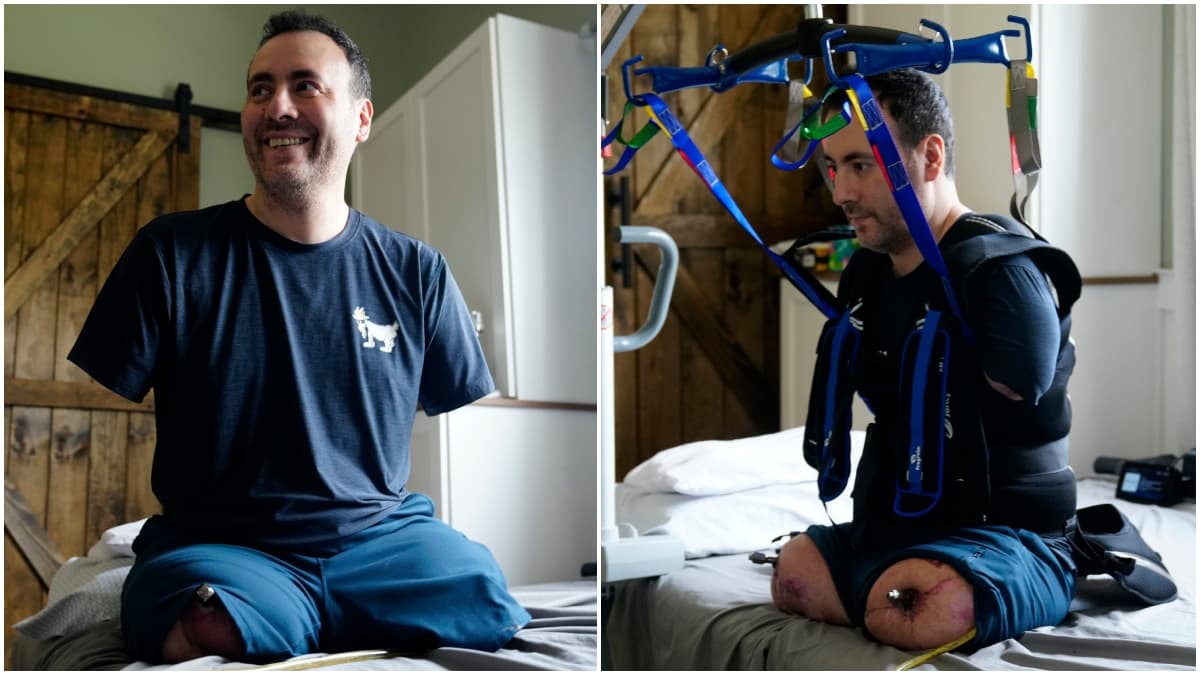 “Hay que seguir adelante”: padre hispano perdió brazos y piernas tras gripe y busca cirugía inédita