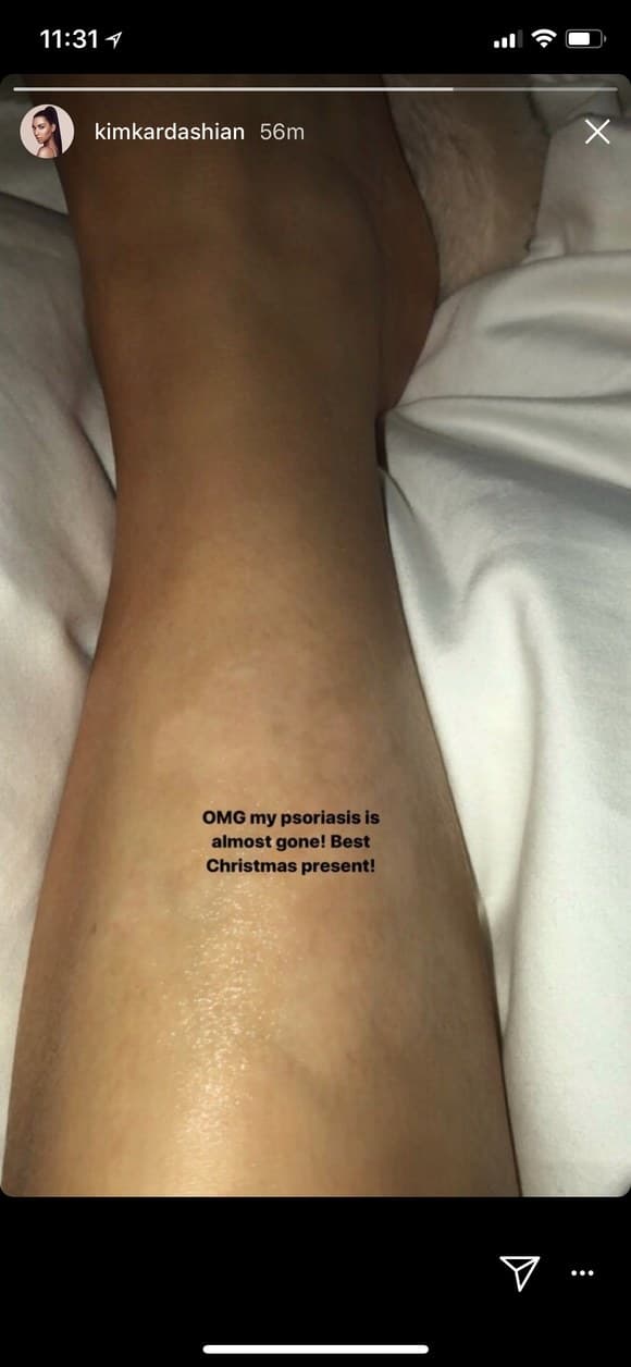 El pasado diciembre, la esposa de Kanye West le confesó a sus más de 107 millones de seguidores en Instagram, que había recibido el mejor regalo de Navidad pues su padecimiento estaba casi erradicado.