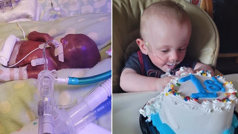 Tenía 0% de supervivencia cuando fue considerado el bebé más prematuro del mundo. Ahora cumple su primer año de vida