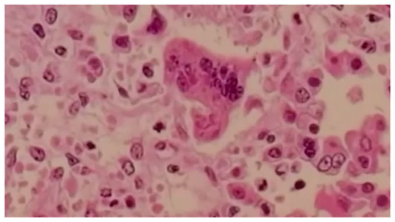 Reportan brote de sarampión en frontera de Utah y Arizona