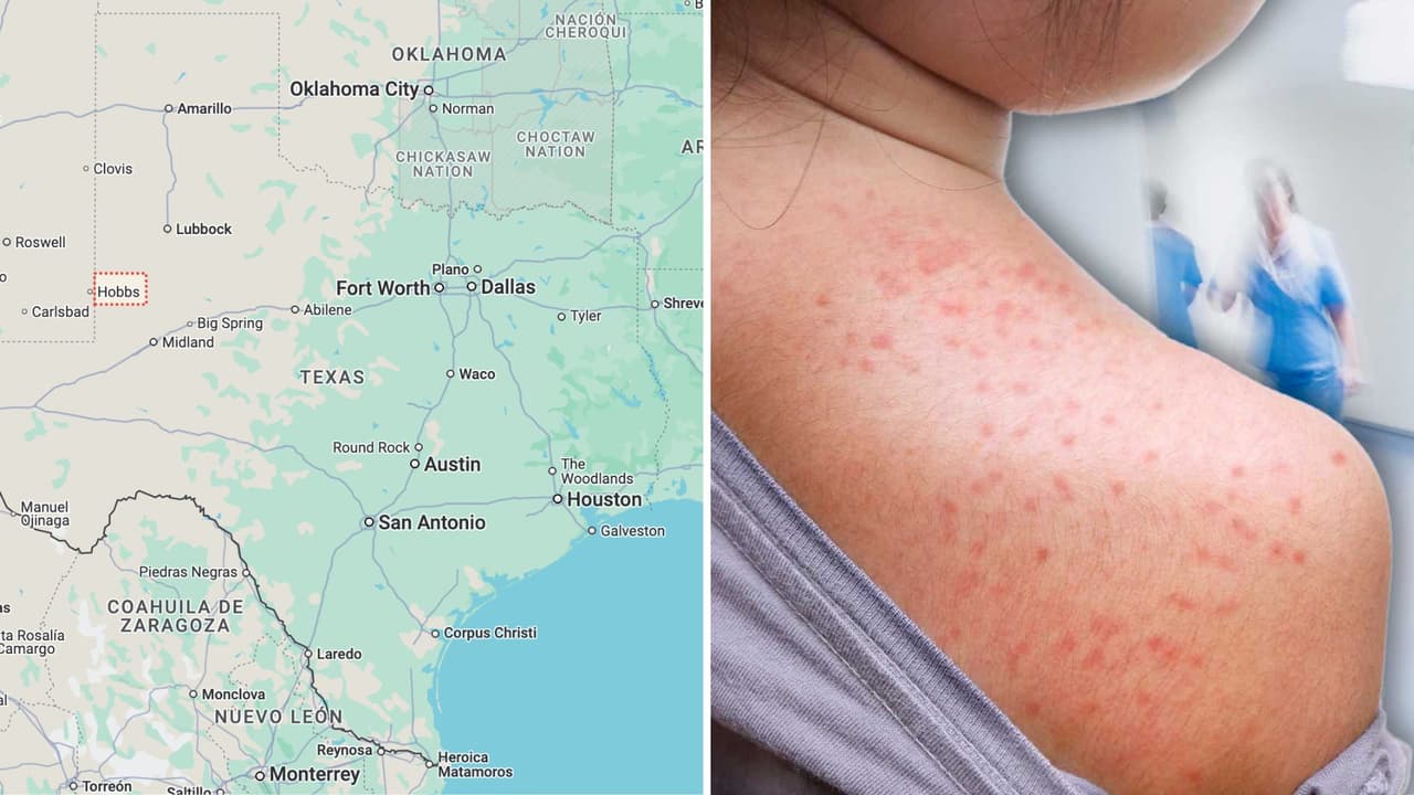 Emiten alerta de salud por brote de sarampión en un condado en Texas: esto es lo que debes saber