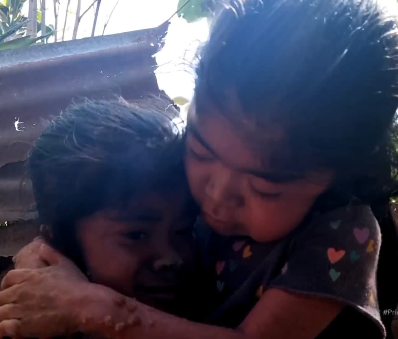 Dos niñas que viven en condiciones de extrema pobreza fueron diagnosticadas con una rara enfermedad de la piel llamada sarcoptosis, un trastorno de la piel que provoca comezón y salpullido por gran parte del cuerpo.
<br>