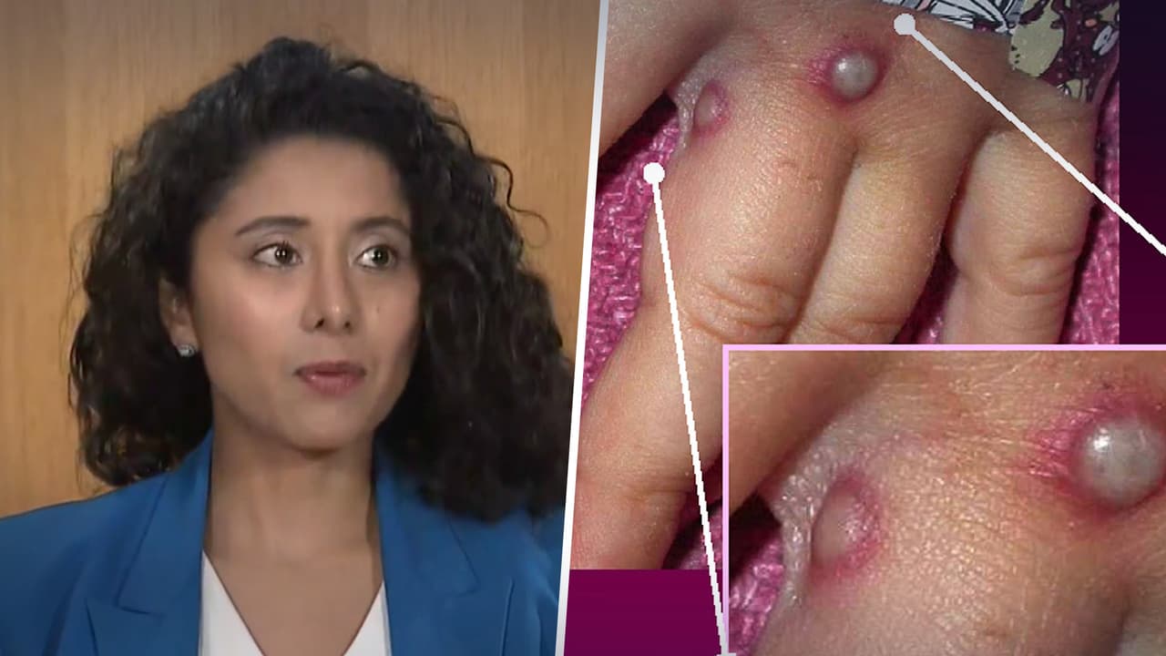 "No tiene viruela del mono": confirman el primer falso positivo de un menor de 2 años en el condado Harris 