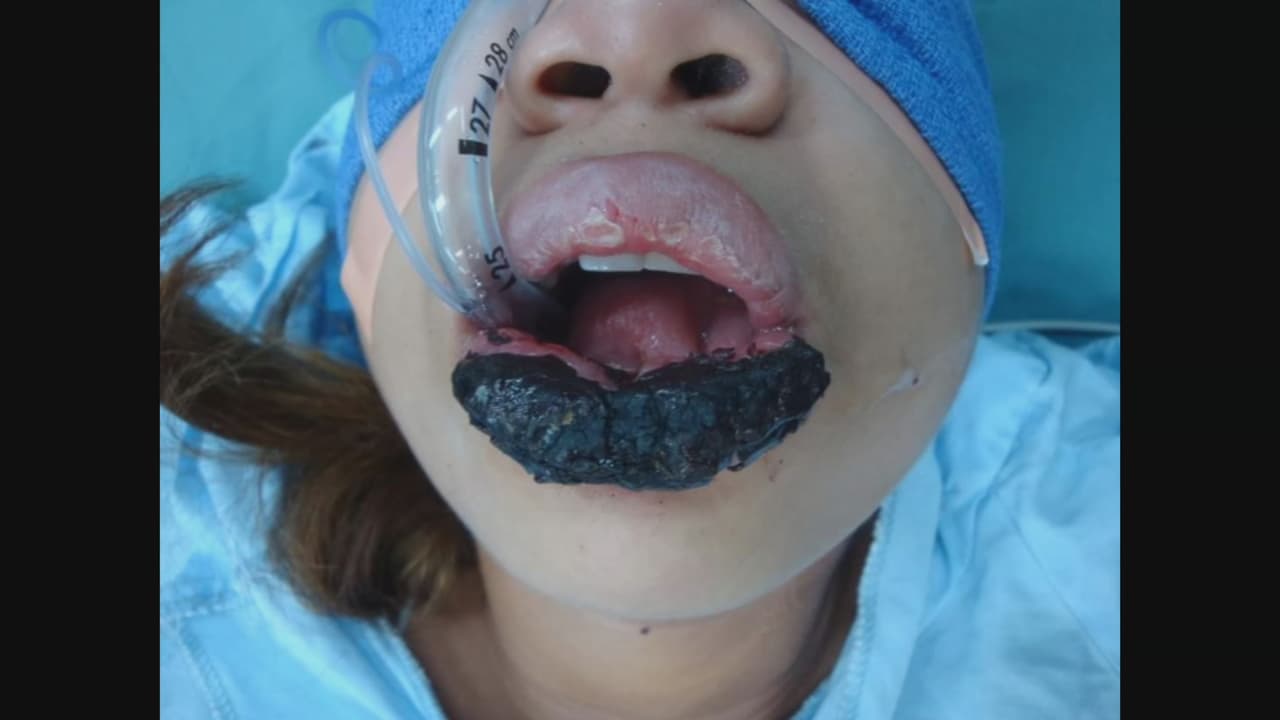 Hace 15 años, cuando la joven panameña Maybeth Coronado sufrió un aparente herpes en su labio superior, 
<b>su madre la llevó de inmediato al seguro social. </b>
<br>