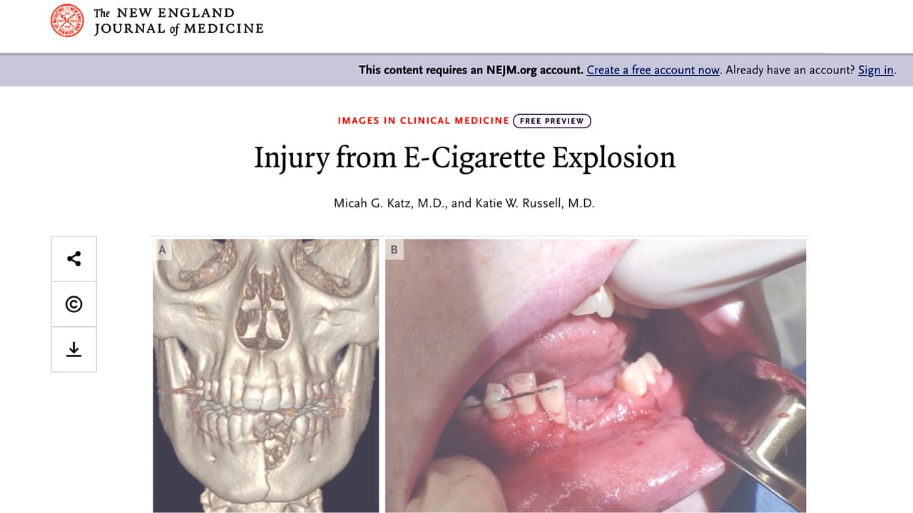 Un adolescente termina con su mandíbula destrozada al explotarle un cigarrillo electrónico