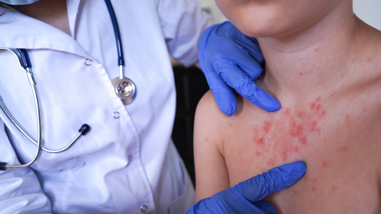 El brote de sarampión en Utah es ya el más activo en Estados Unidos: Informe