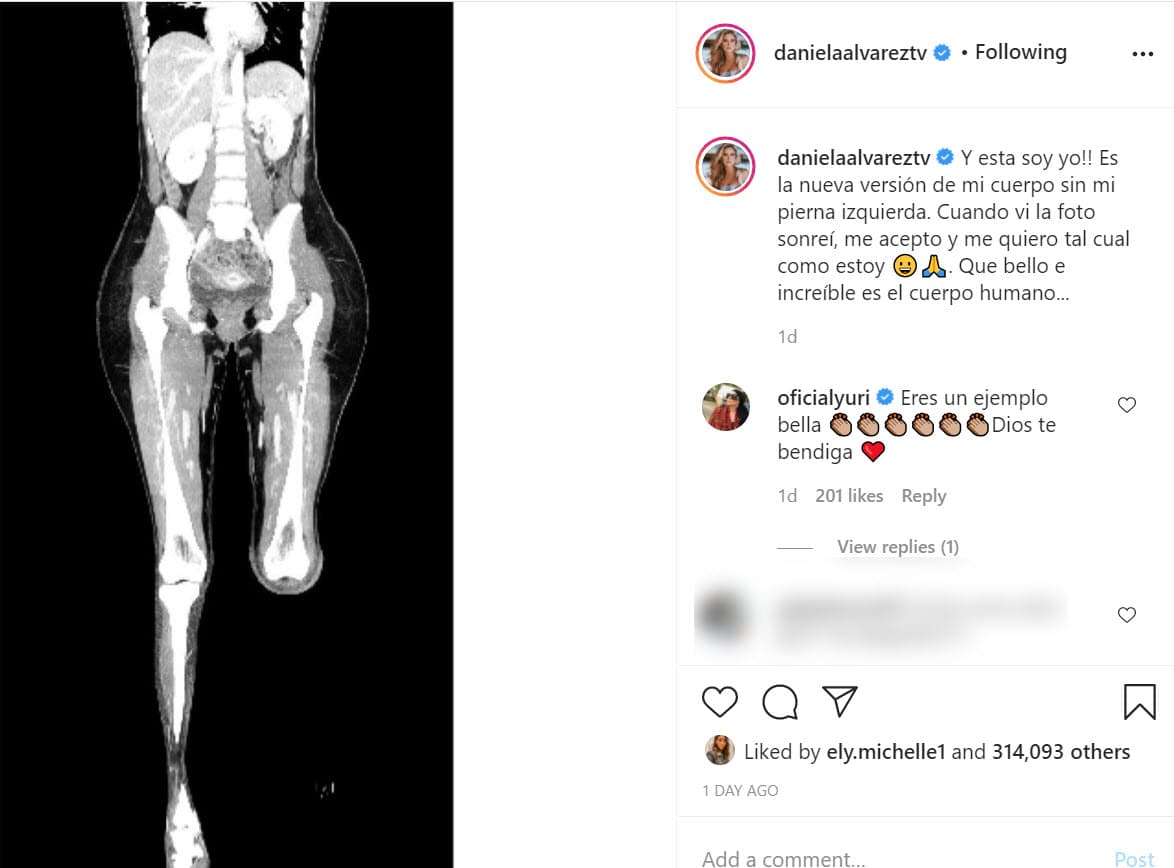 Se trata de esta radiografía en la que se observa lo que calificó como
<b><a href="https://www.instagram.com/p/CH3NBBip4mX/" target="_blank"> la "nueva versión" </a></b>de ella misma sin la pierna. 
<br>