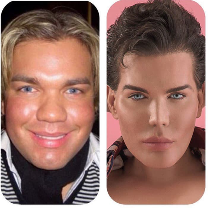 El antes y después de Rodrigo Alvés, el llamado 'muñeco humano'.