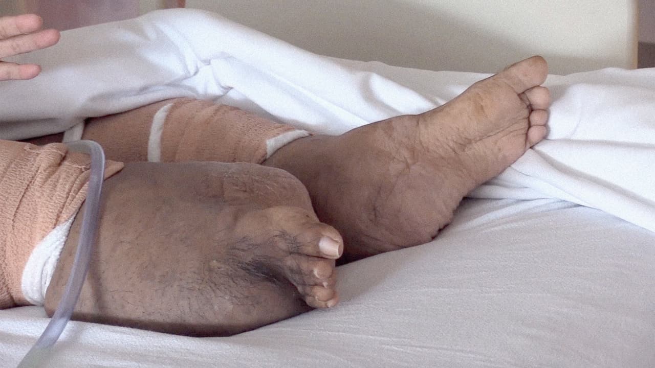 La extraña enfermedad le provoca el crecimiento descontrolado de tumores en el cuerpo. En este caso, en sus piernas.