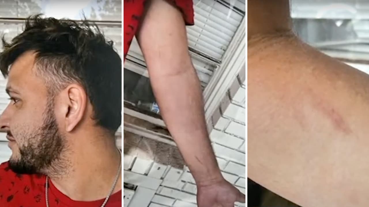 Estas fueron las fotografías presentadas durante el juicio en referencia a los razguños y marcas en el cuello de José Ibarra tras el asesinato de Laken Riley.