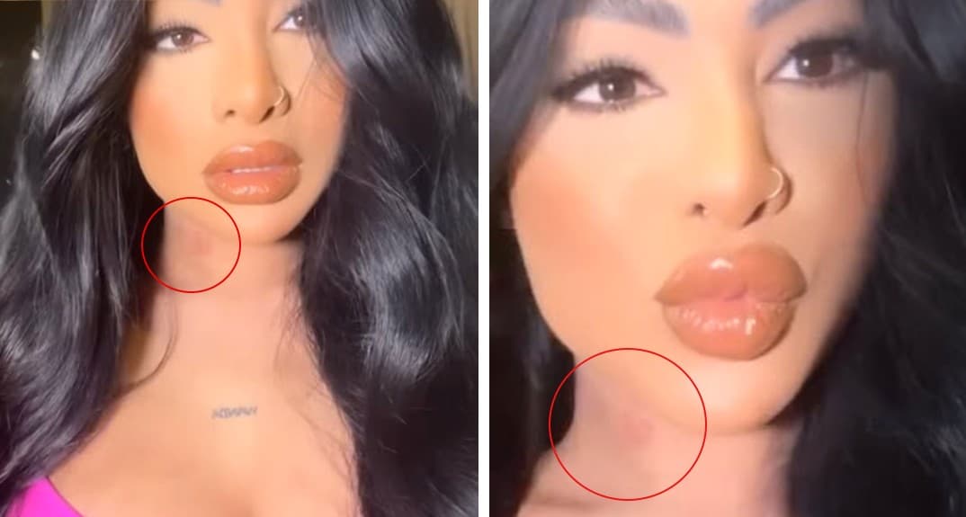 Yailin La Más Viral aparece con una marca en el cuello.