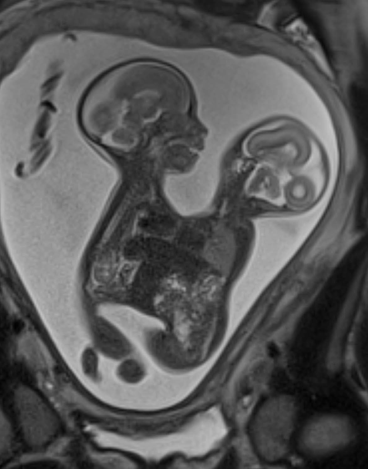 Una serie de análisis confirmó que las niñas compartían el hígado y el diafragma; sin embargo, cada una tenía un corazón saludable, lo que las hacía candidatas para la separación.