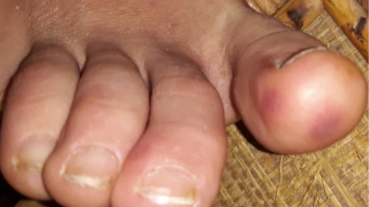 Ostrosky explicó que se trata de un mecanismo donde anticuerpos y células del sistema inmune están reaccionando fuertemente a la presión del coronavirus en el cuerpo,