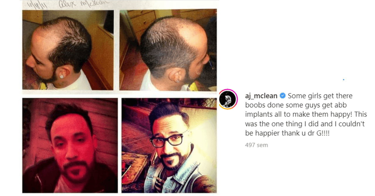 A.J. McLean antes y después de su procedimiento capilar