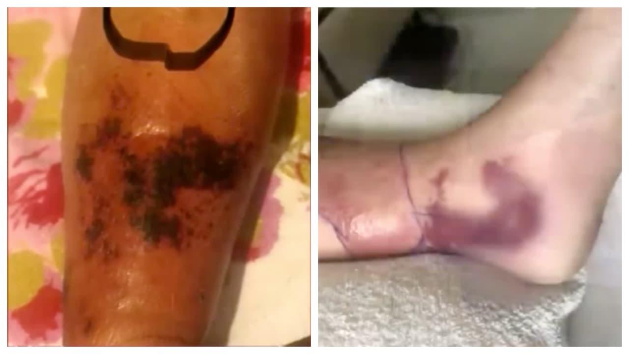 Dos infectados por bacterias ‘come carne’ y ameba ‘come cerebro' tras nadar en Florida