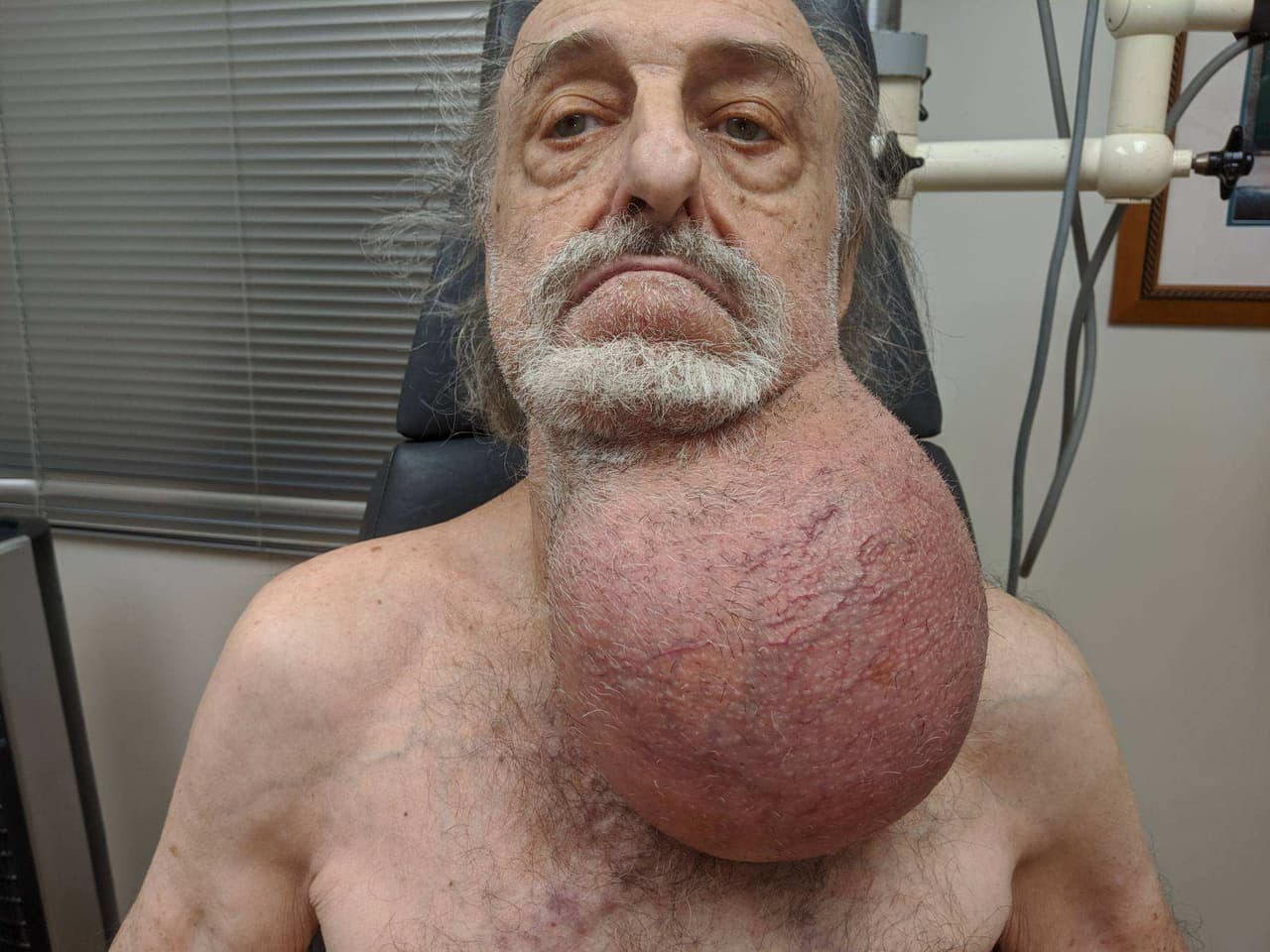 Médicos de Nueva York extirpan tumor que era más grande que la cabeza del paciente