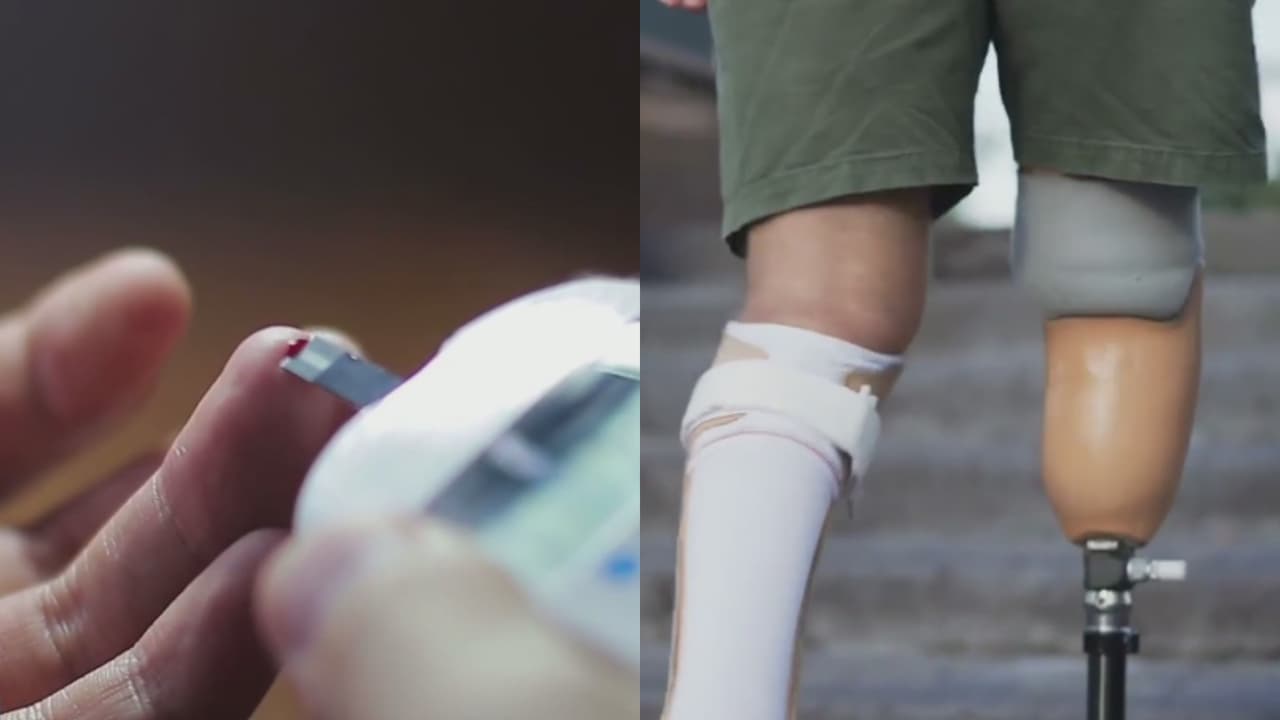 Alerta por cifra de amputaciones por diabetes en condado Bexar: así puedes prevenir esta enfermedad