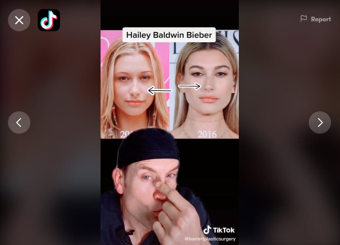 En el video él dice que "los cambios físicos son imposibles sin algunos procedimientos cosméticos específicamente en su nariz", refiriéndose a la de la modelo de 23 años.
<br>