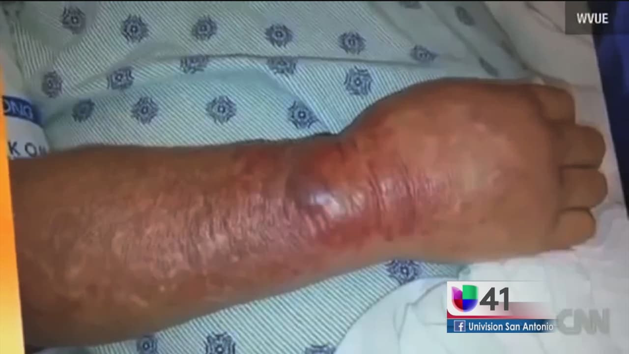 Mujer alerta sobre peligrosa bacteria en playas de Texas