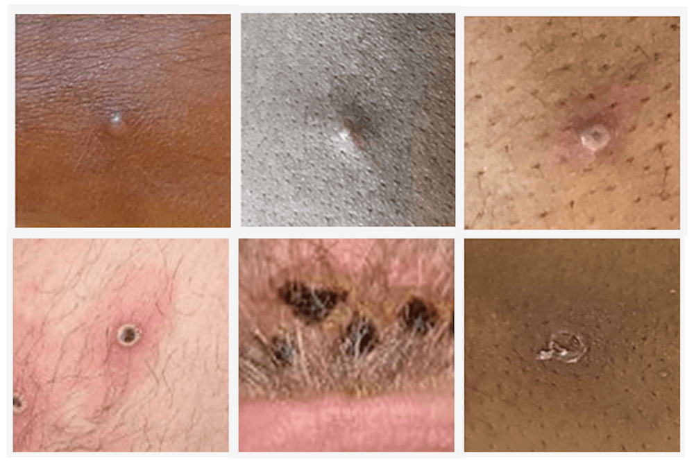 Lesiones causadas por la viruela del mono.