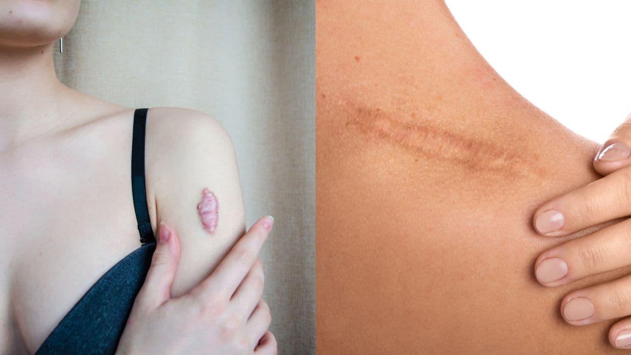 Cómo quitar cicatrices queloides de forma natural: el secreto está en tu propia casa