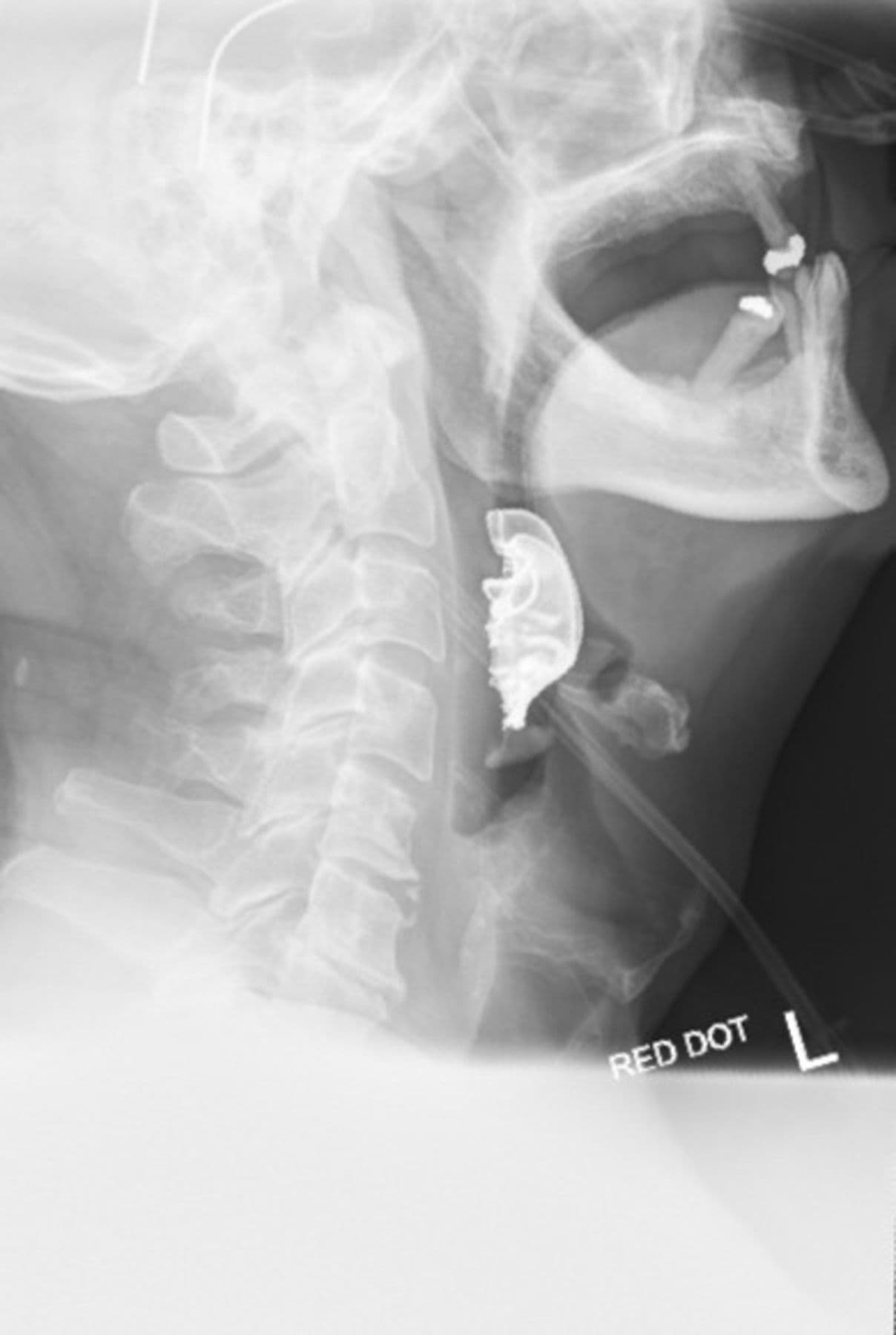 Radiografía lateral del cuello. Proporcionada por BMJ.
<br>