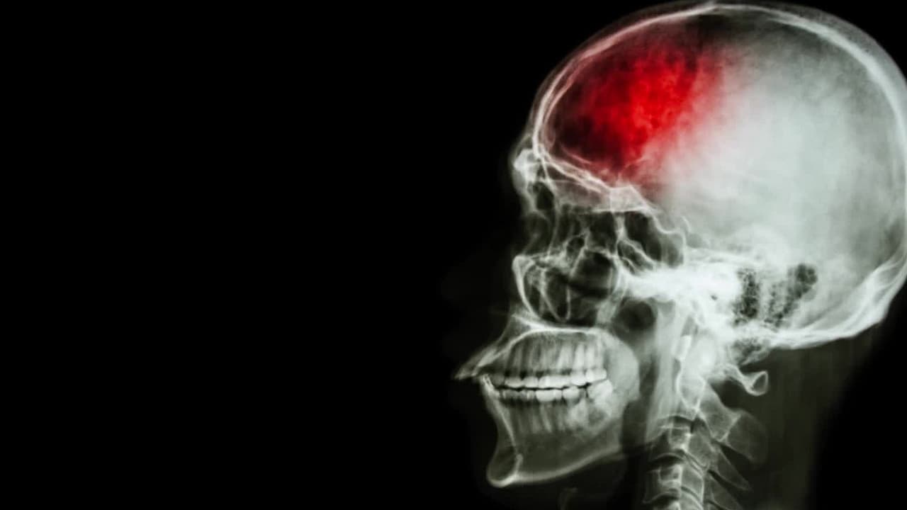 Los derrames cerebrales afectan más a la población hispana