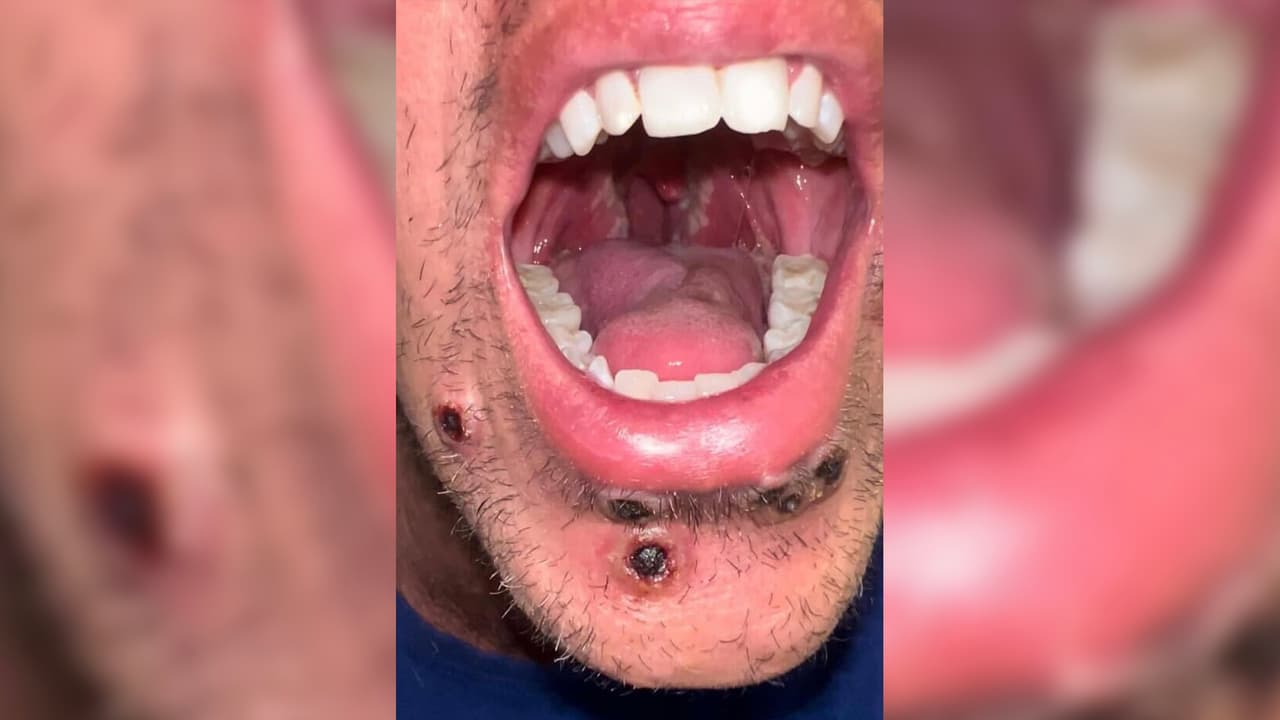 <b>Los síntomas de la viruela del mono son:</b>
<br>-Dolor del cuerpo.
<br>-Dolores de cabeza.
<br>-Inflamación de los ganglios.
<br>-Fiebre.
<br>-Lesiones en la piel clásicas de la viruela.