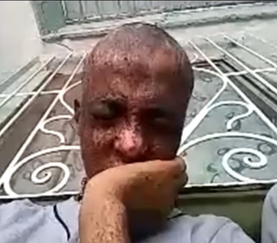 Durante mucho tiempo, Fernando Núñez se entregó a la desazón y
<b> no quiso luchar más contra ese cáncer de piel que le fue diagnosticado desde muy pequeño</b>, sin encontrar esperanza alguna en todos los doctores que lo atendían. 
<br>