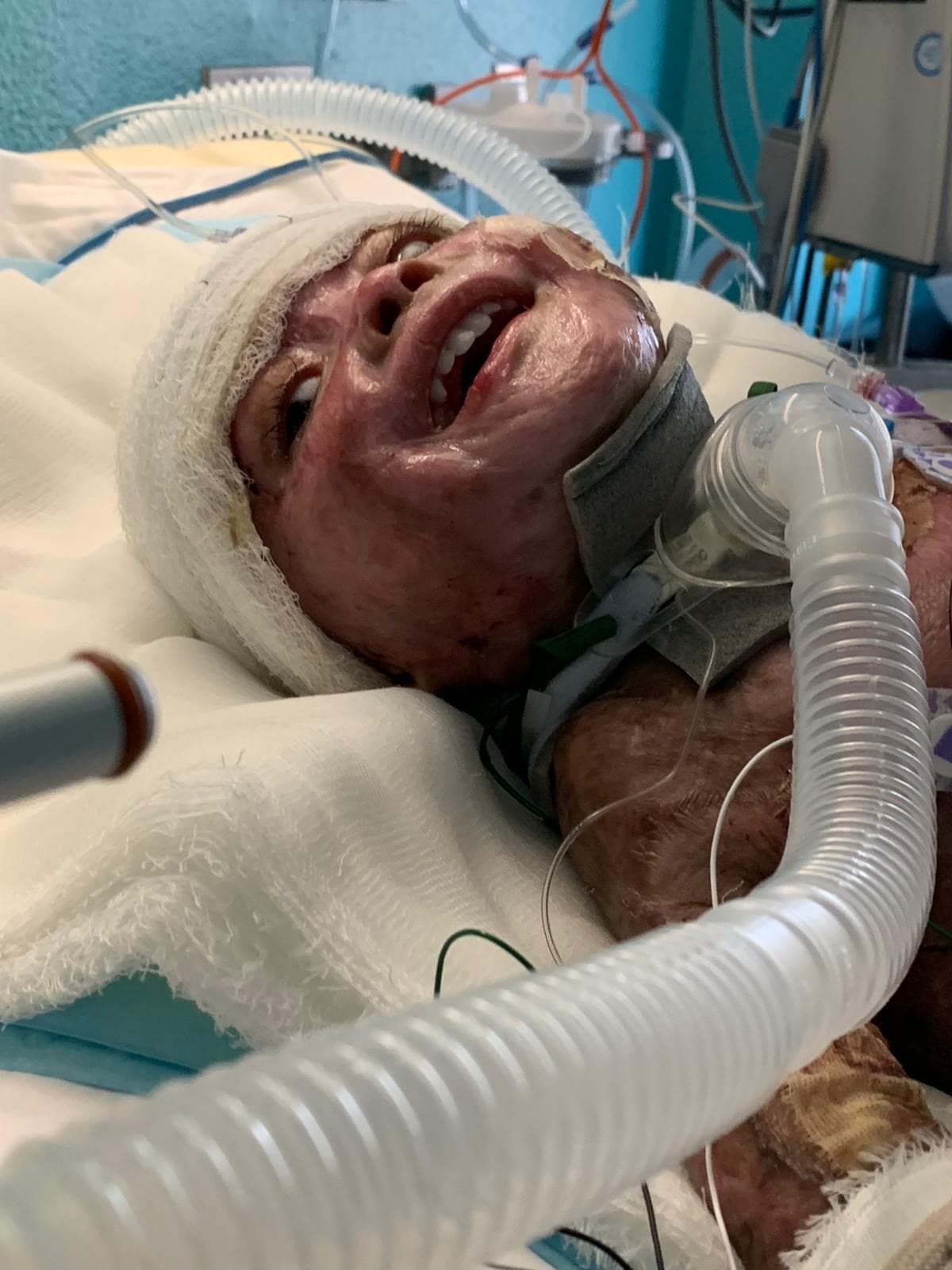 Ayuda de Impacto: Su madre murió en un incendio provocado y él sufrió el 95% de su cuerpo