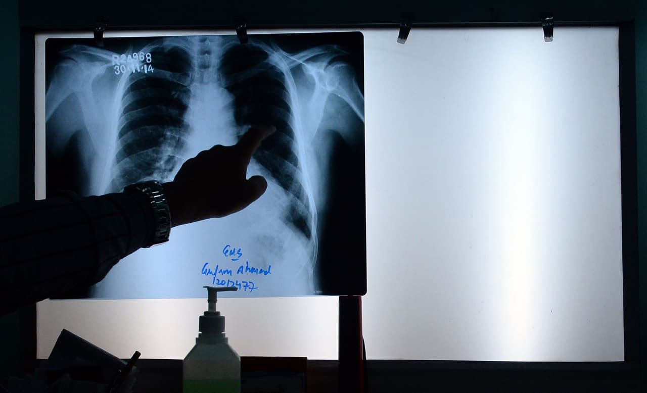 El cáncer es una enfermedad en la que algunas de las células del cuerpo comienzan a crecer sin control.