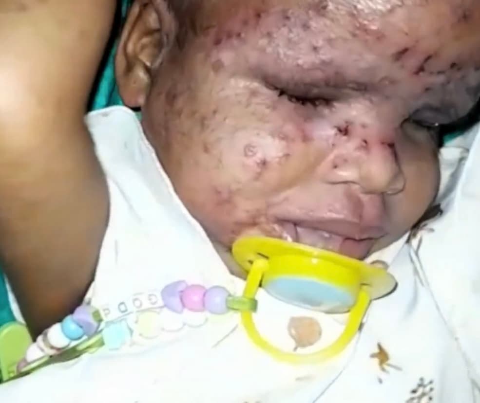 Esta situación tiene en vilo a los seres queridos de la menor, quienes intentan ponerle la mejor cara a esta tempestad. “Es muy desesperante, porque su dolor es mi dolor”, dice Pamela sobre su hija, quien todos los días intenta vivir con una sonrisa, mientras no para de rascarse. 
<br>