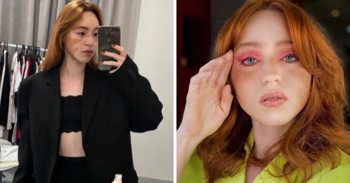 A los 14 años le detectaron vitíligo: dio lecciones de amor propio y se convirtió en modelo