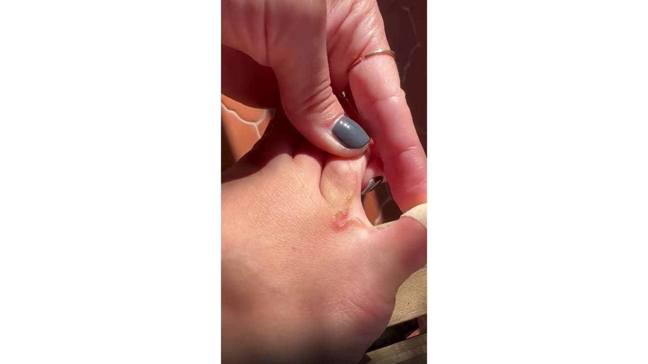 Lucía Pombo mostró cómo se ve el gusano que tiene en el pie.