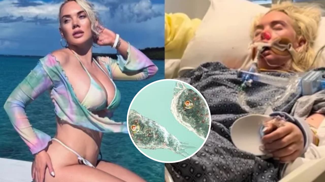 Amputan pierna de mujer de Georgia tras infectarse de bacteria "come carne" 