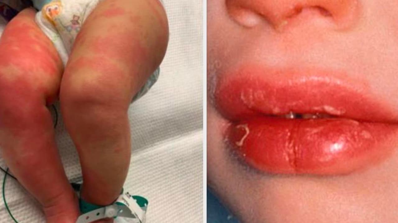 Carolina del Norte reporta el primer caso de la enfermedad infantil asociada al coronavirus